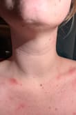 I wore this dress to a black tie wedding, and it was gorgeous. That being said - the fabric of the dress left the most painful bubbling rash around my neck and chest where the fabric met my skin. Under my arms started breaking out too after they rubbed against the dress. So painful and the rash hasn't gone away two days later! - Shannon P.